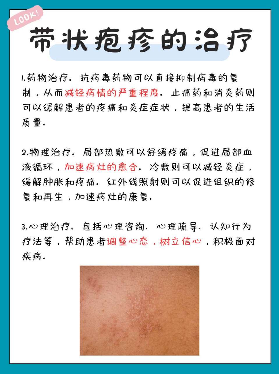 🔥👩‍⚕️📚  带状疱疹的典型症状包括