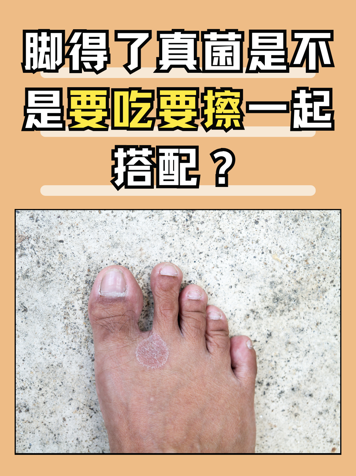 脚真菌感染,也就是我们常说的足癣,是一种由真菌感染引起的皮肤病