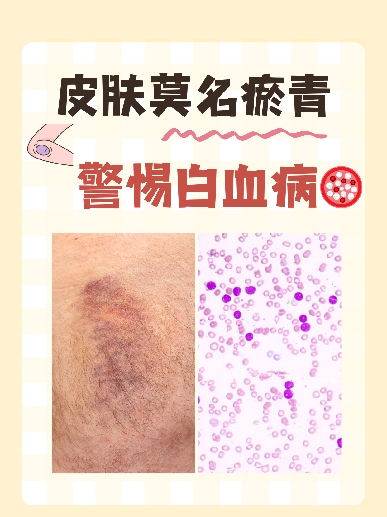 皮肤莫名瘀青警惕白血病