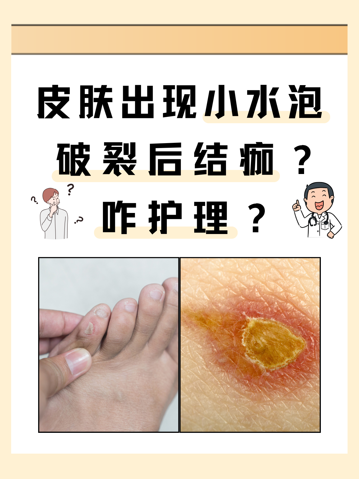 结痂为什么痒 结痂为什么痒