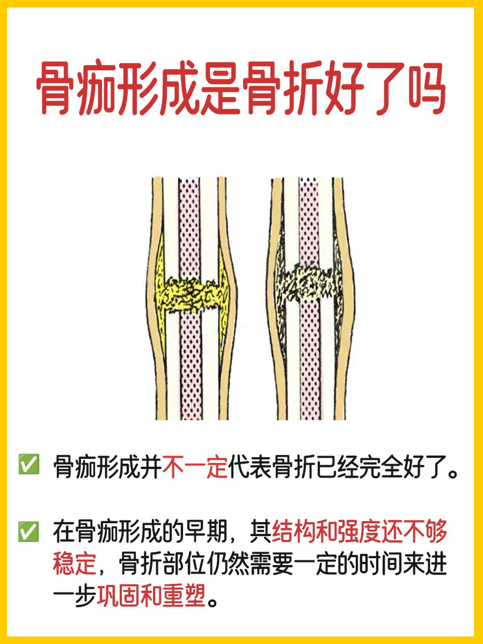 骨痂生长过程图 骨折图片