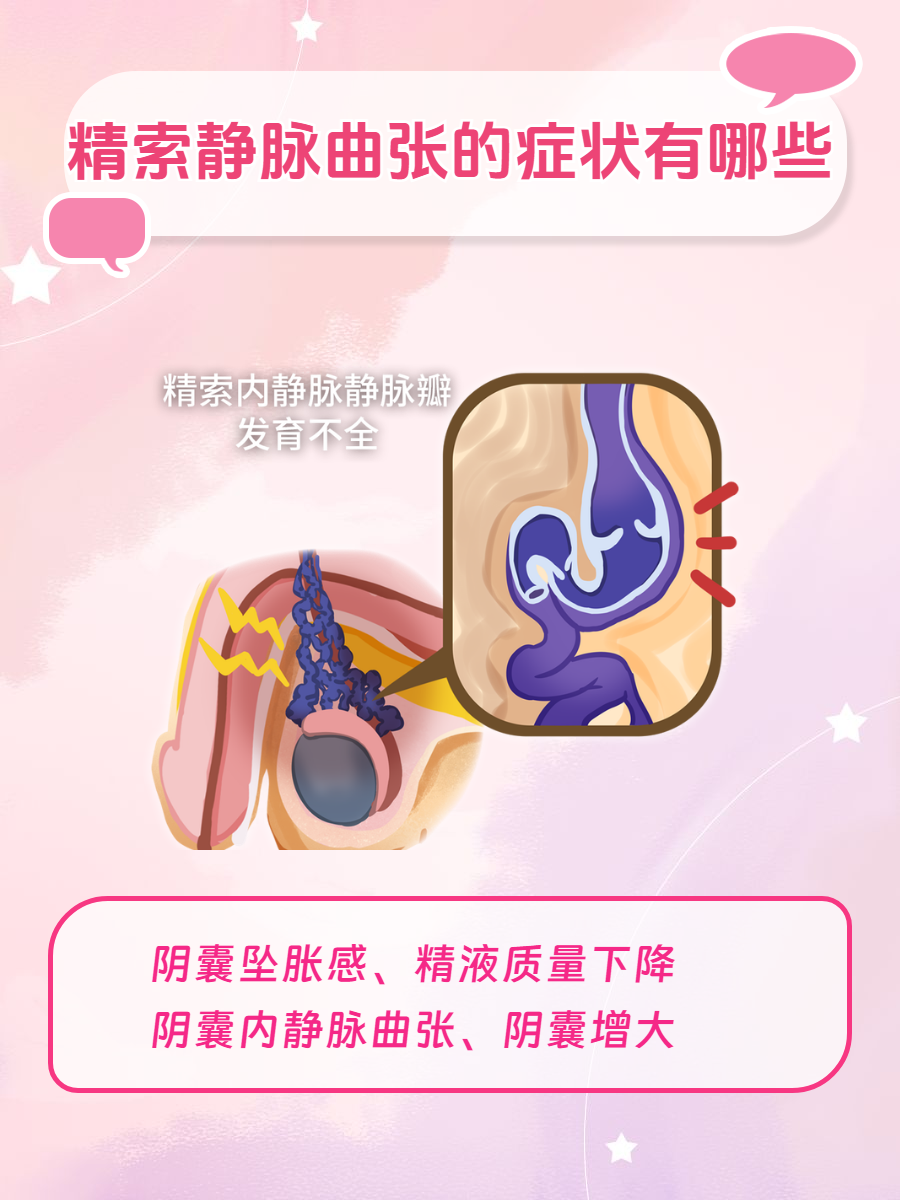 精索静脉曲张的症状有哪些?快来了解!