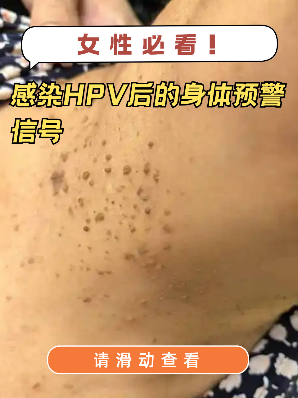 感染hpv后的身体预警信号