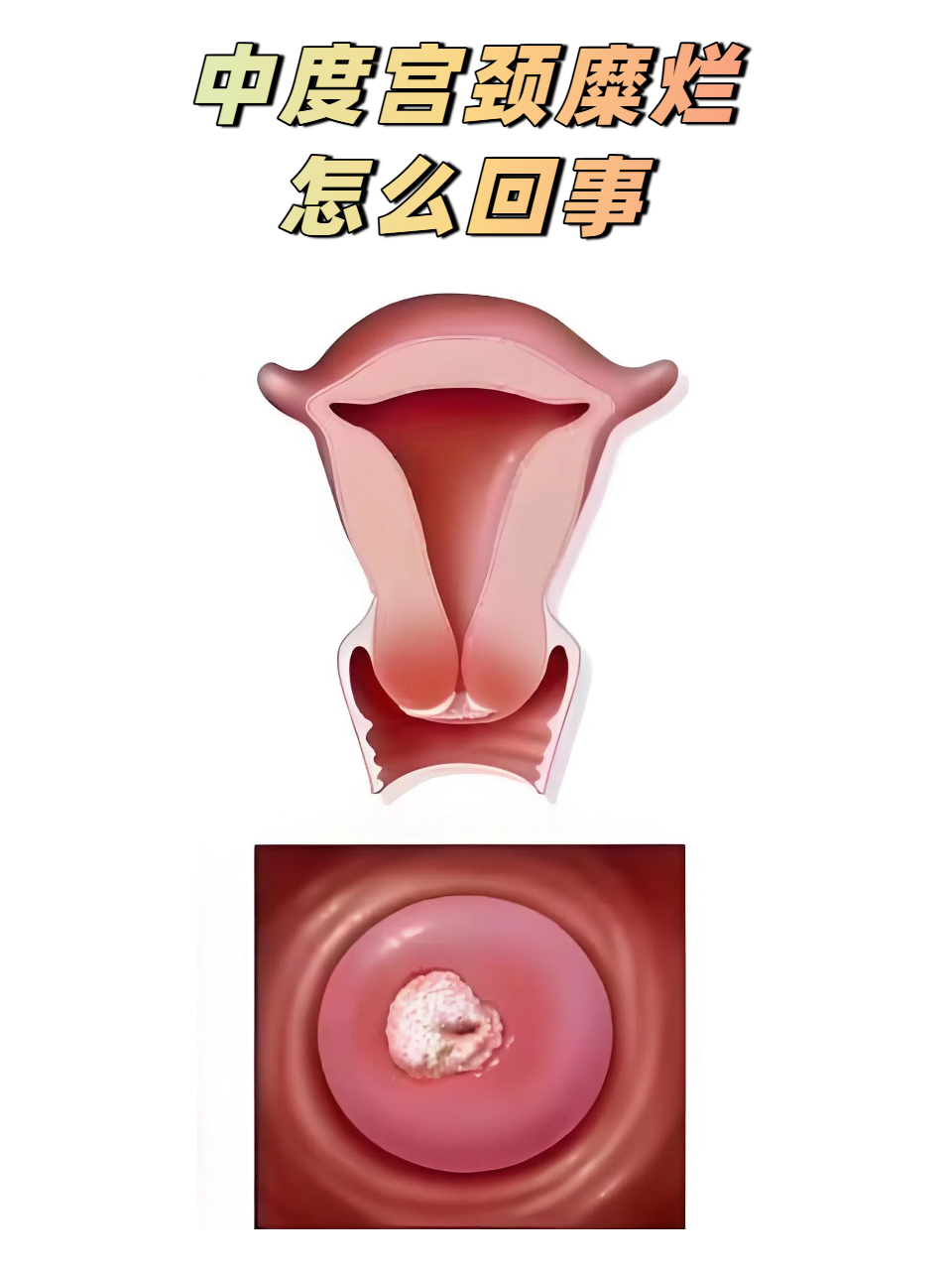 中度宫颈糜烂怎么回事