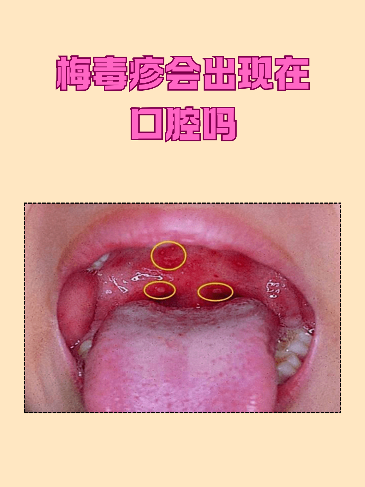 梅毒疹会出现在口腔吗