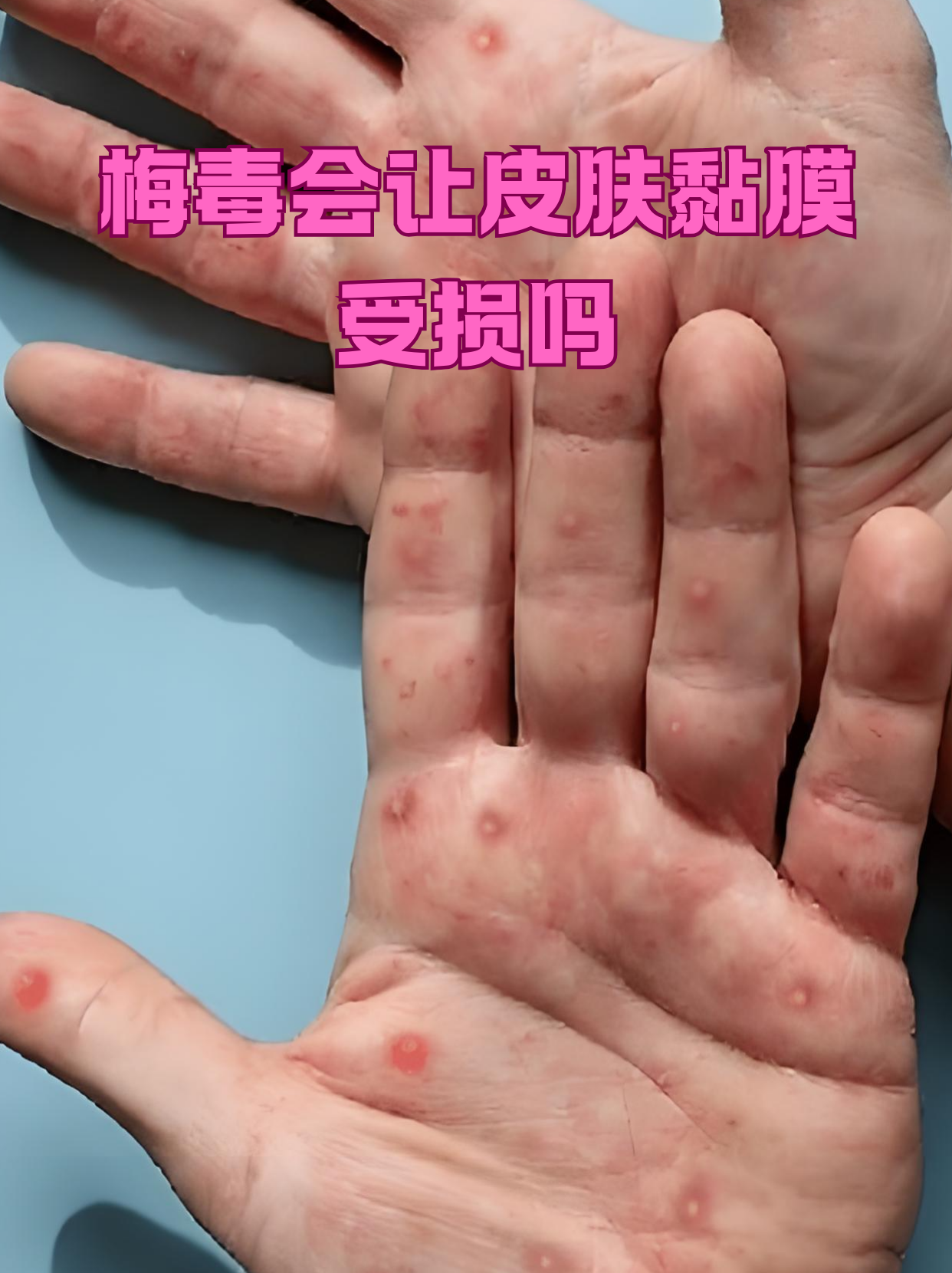  hp是什么病毒感染引起的(感染hpv51型有什么症状吗)