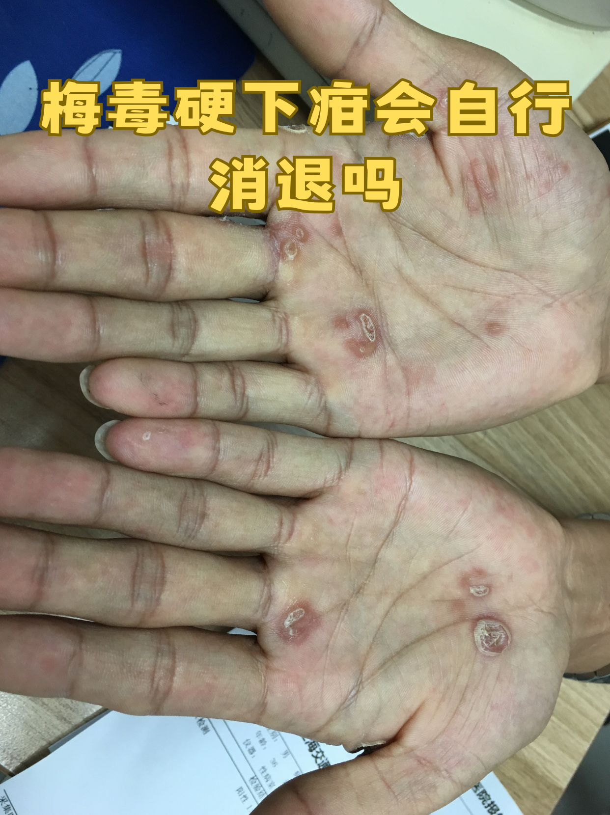 硬下疳是梅毒一期的典型表现,表面看似"愈合"实则病原体已潜入血液,若