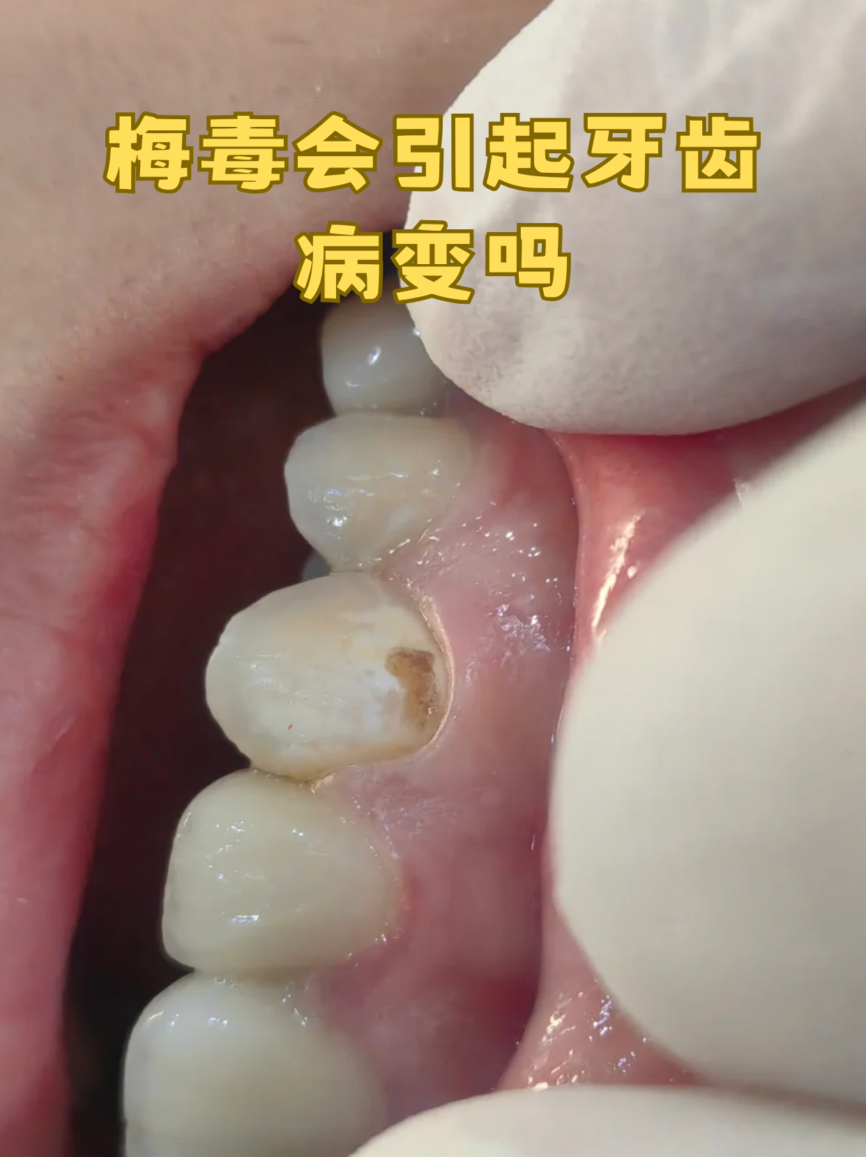 梅毒会引起牙齿病变吗