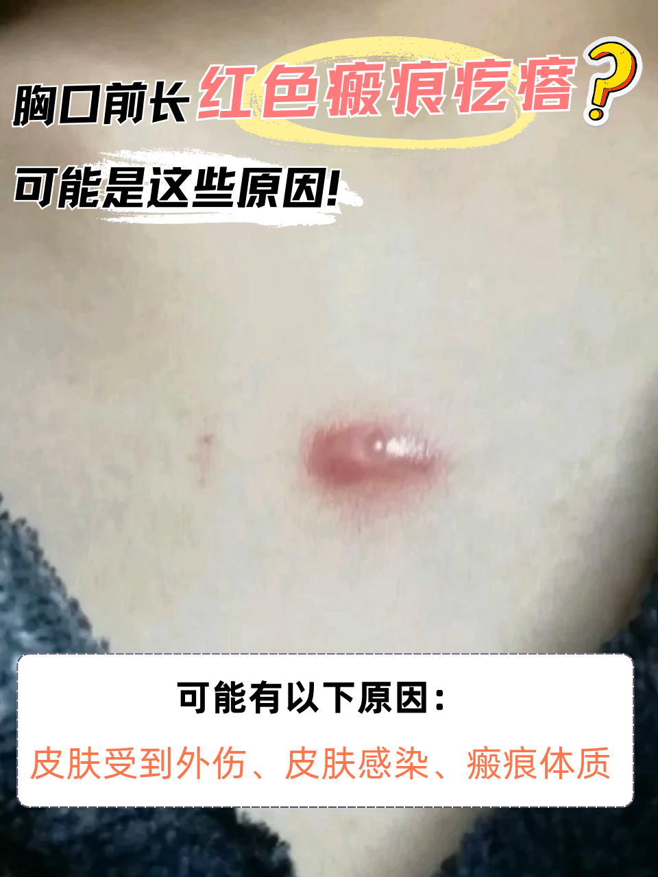 胸口前长红色瘢痕疙瘩?可能是这些原因!