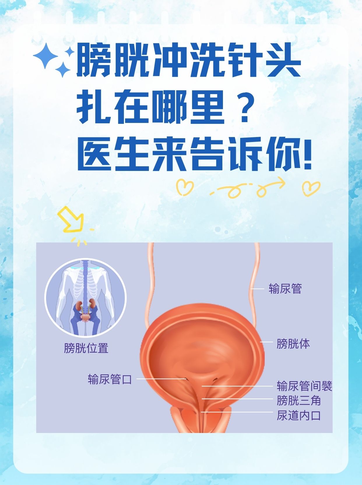 膀胱冲洗针头扎在哪里?医生来告诉你!