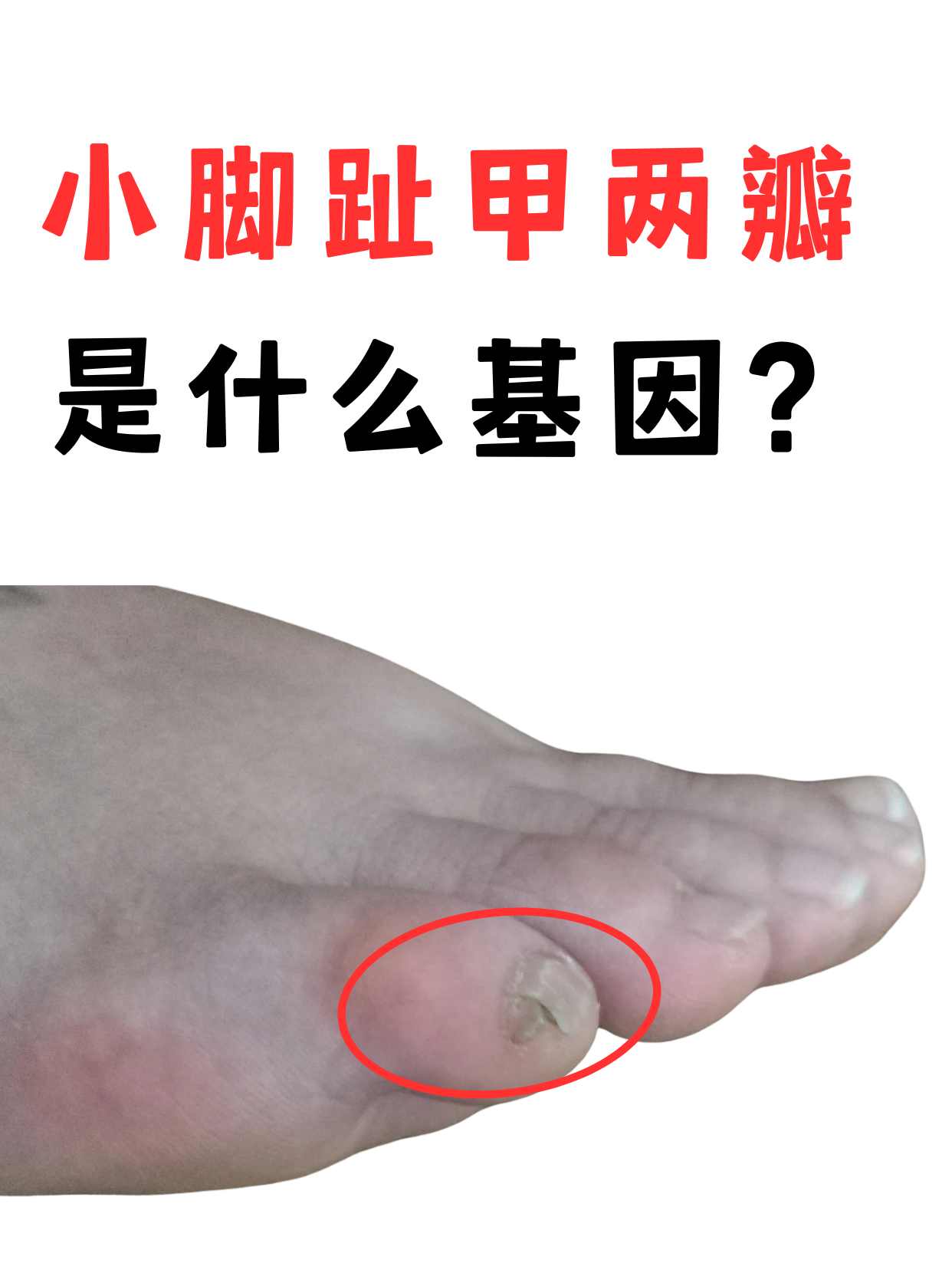 小脚趾甲两瓣在医学上又称瓣状甲,相关研究表明,主要受常染色体显性