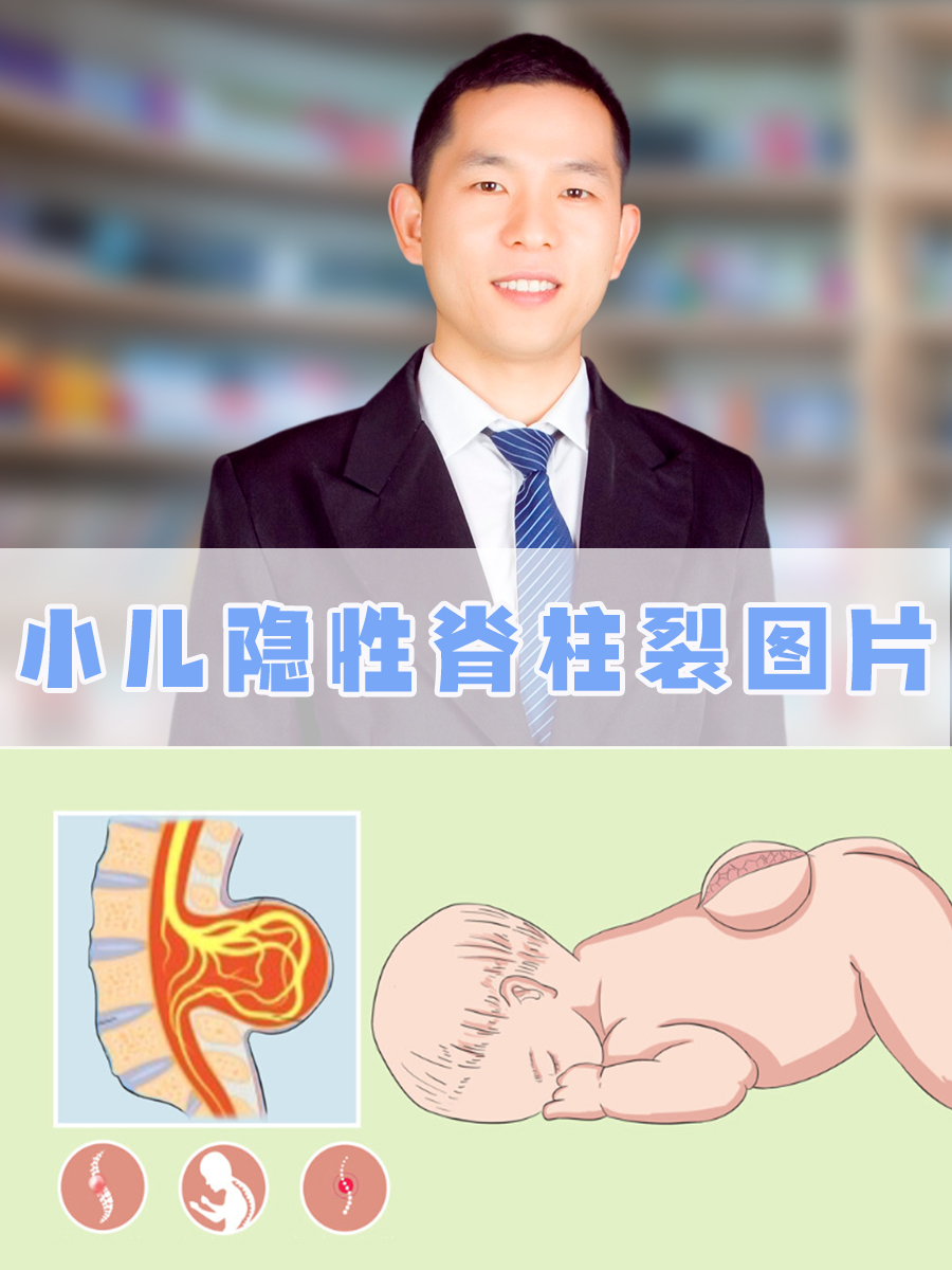 所以叫做"隐性",出现这样情慷 脊柱裂的症状图片先天性脊柱裂真人