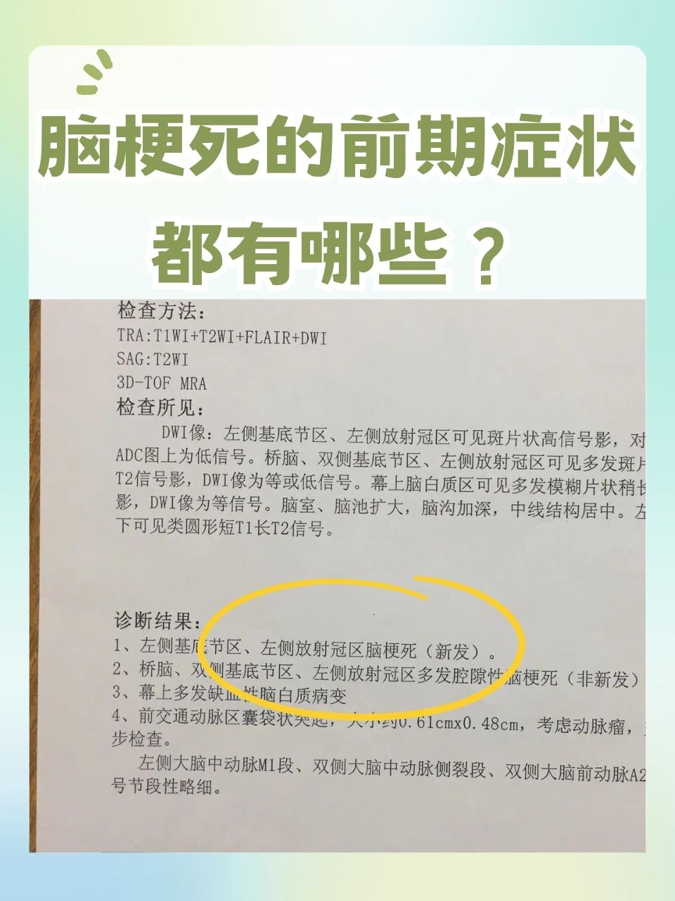 你知道吗?脑梗死危害极大,前期症状不容忽视.