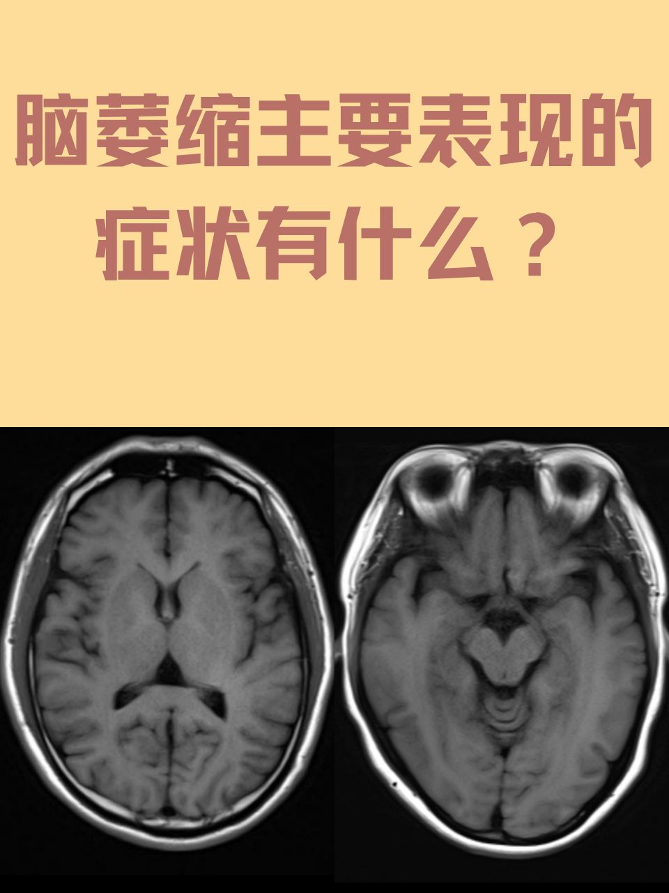 在现代社会,脑萎缩逐渐成为人们关注的健康问题之一