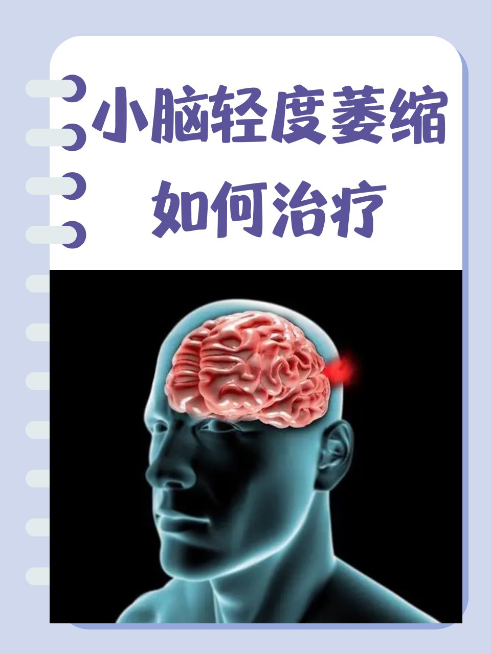 尽管小脑萎缩目前尚无直接治愈的方法,但通过合理的治疗和日常护理