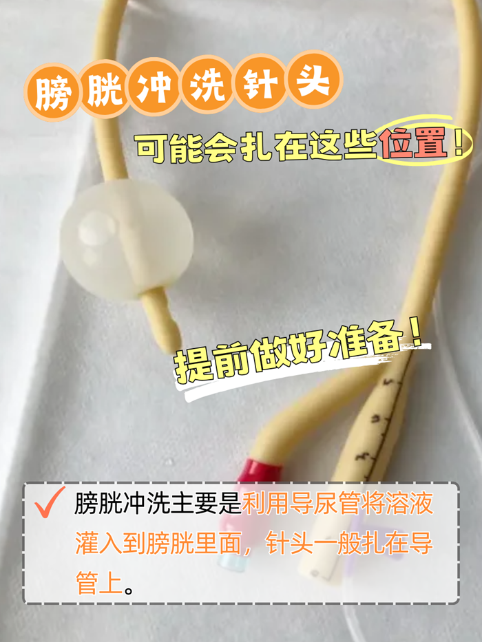 膀胱冲洗针头可能会扎在这些位置!提前做好准备!