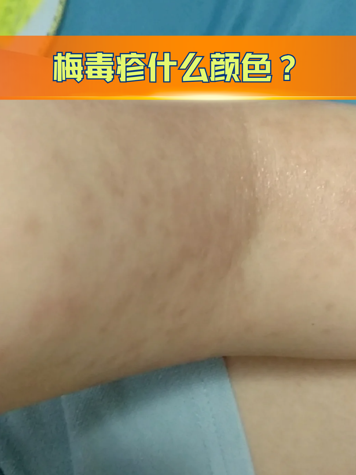 梅毒疹什么颜色?