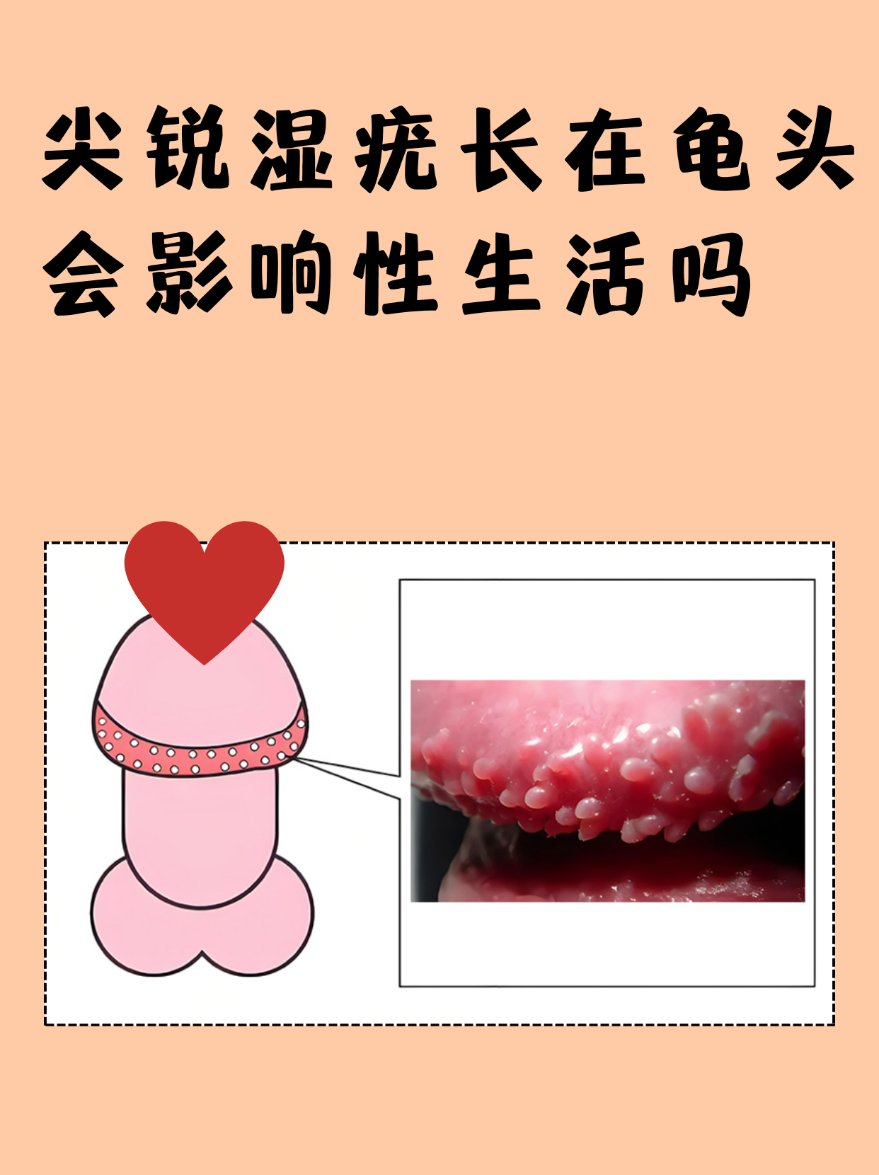 尖锐湿疣对性生活的影响 症状表现:疣体摩