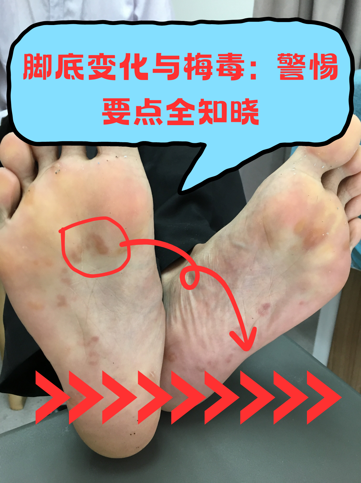 脚底变化与梅毒:警惕要点全知晓