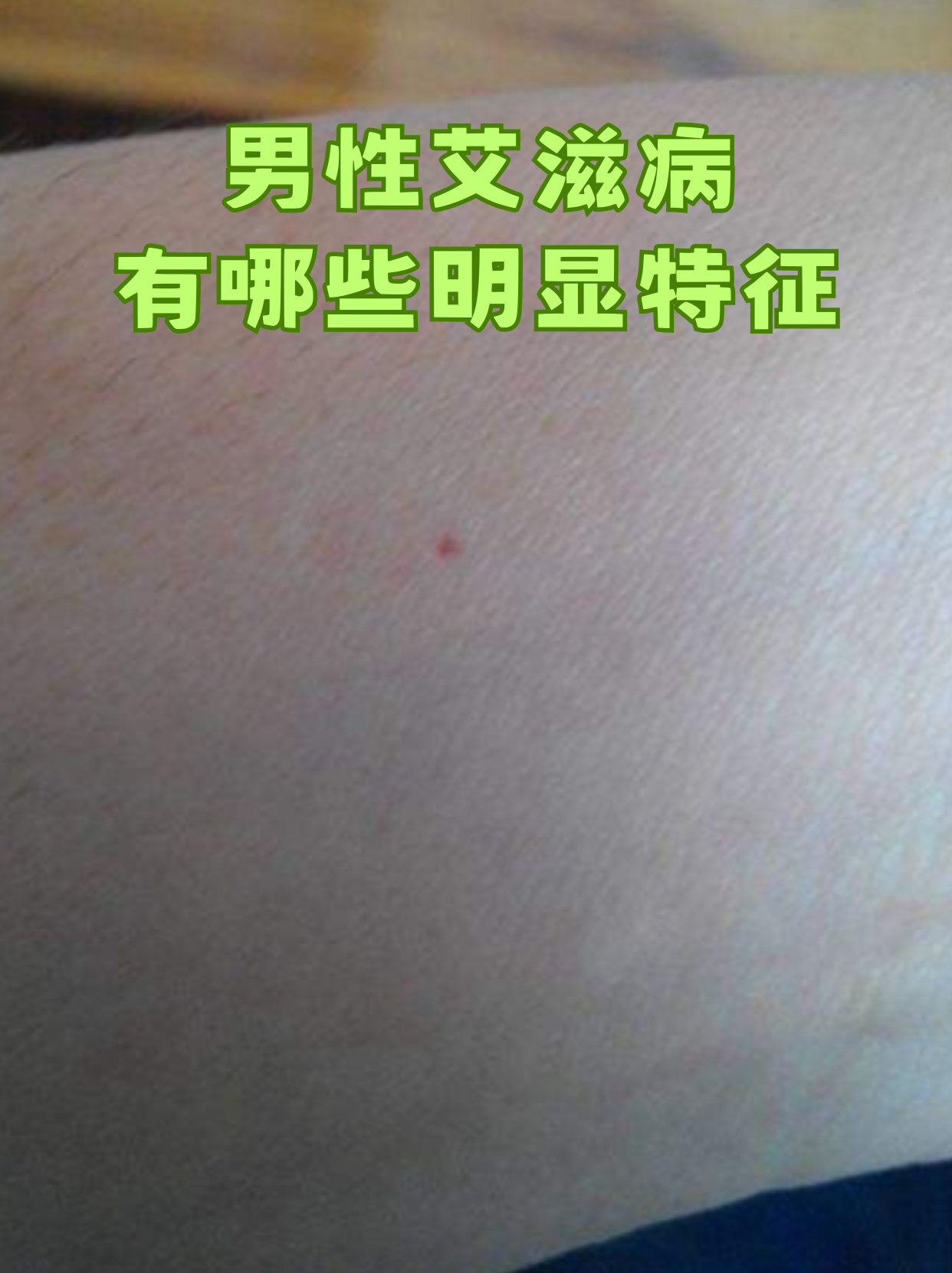 男性艾滋病,有哪些明显特征
