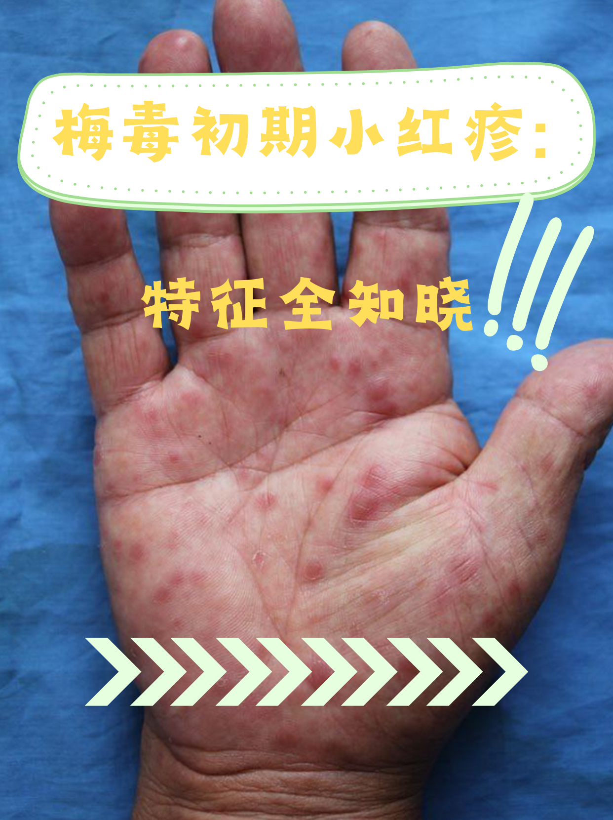 梅毒初期小红疹:特征全知晓