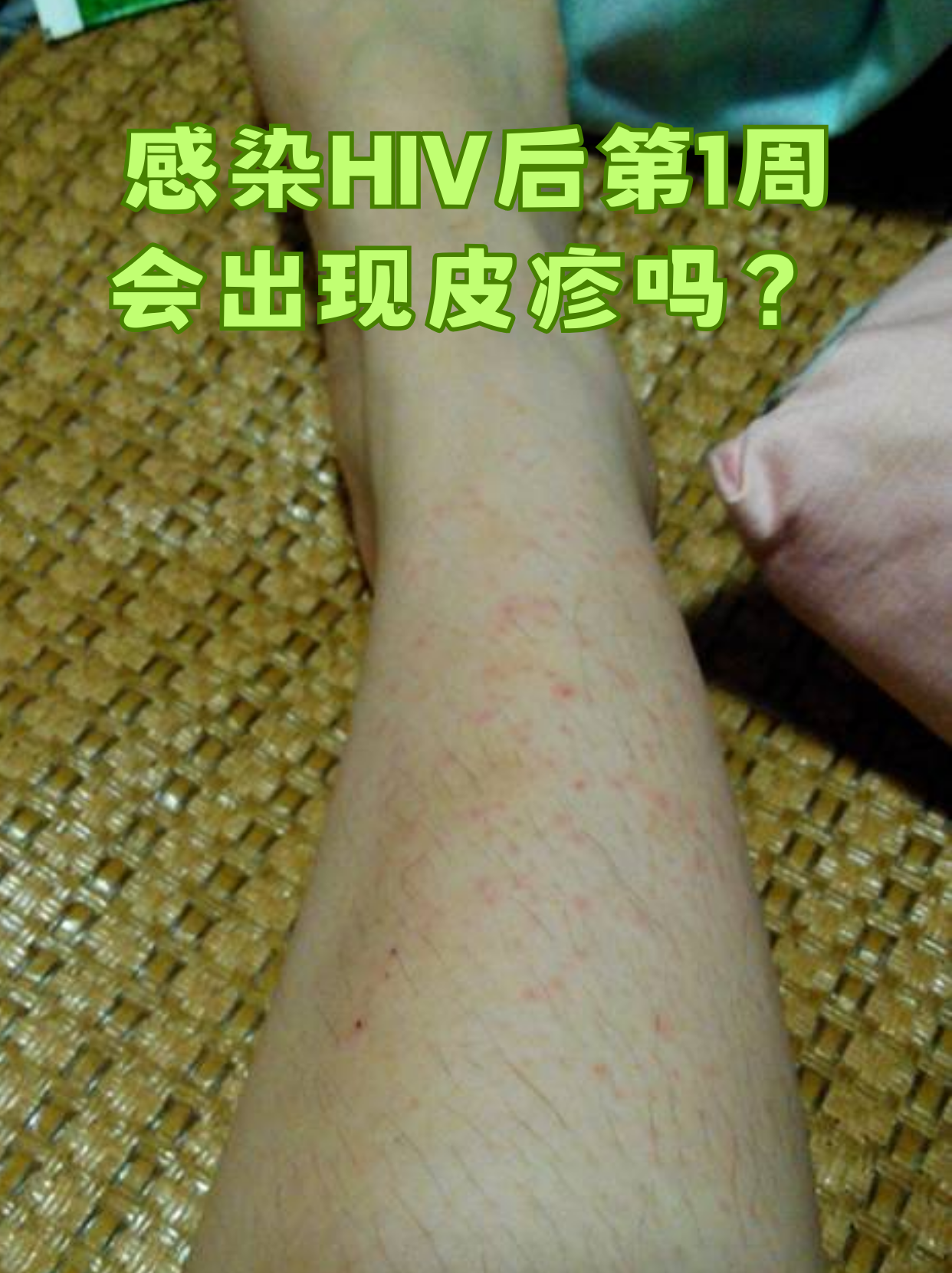  春季病毒感染的症状是什么(春季病毒感冒吃什么药)
