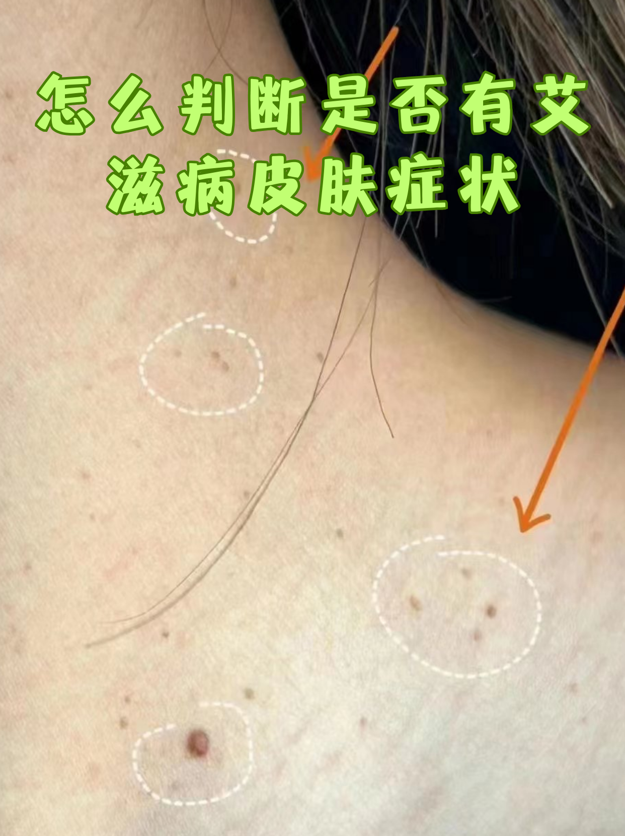 怎么判断是否有艾滋病皮肤症状