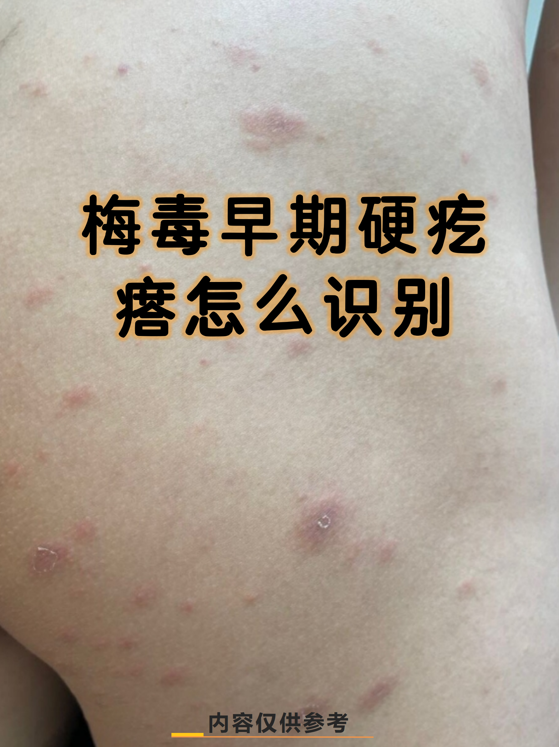 梅毒早期硬疙瘩怎么识别