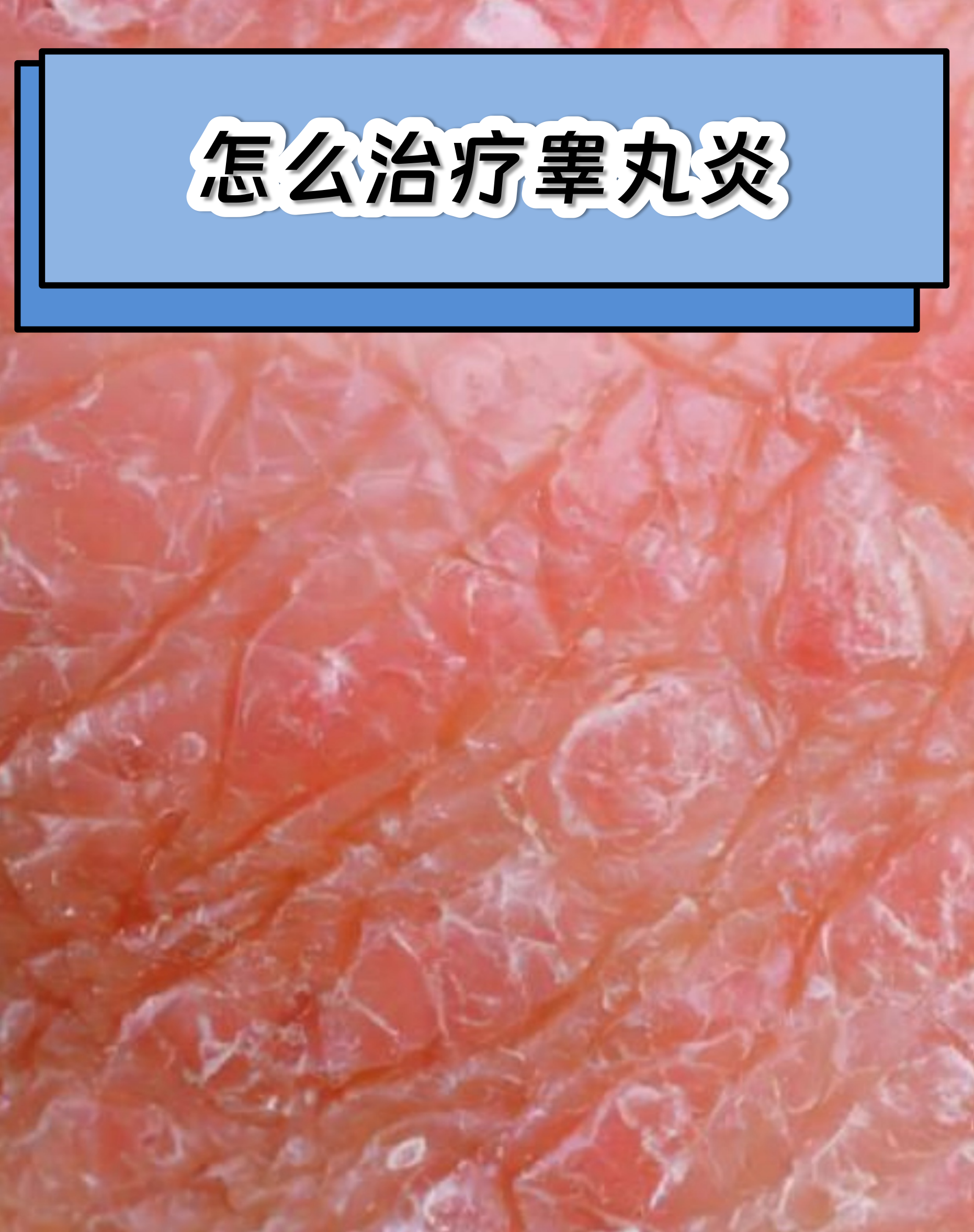 睾丸炎是男性常见的生殖系统炎症,常伴随疼痛,肿胀等