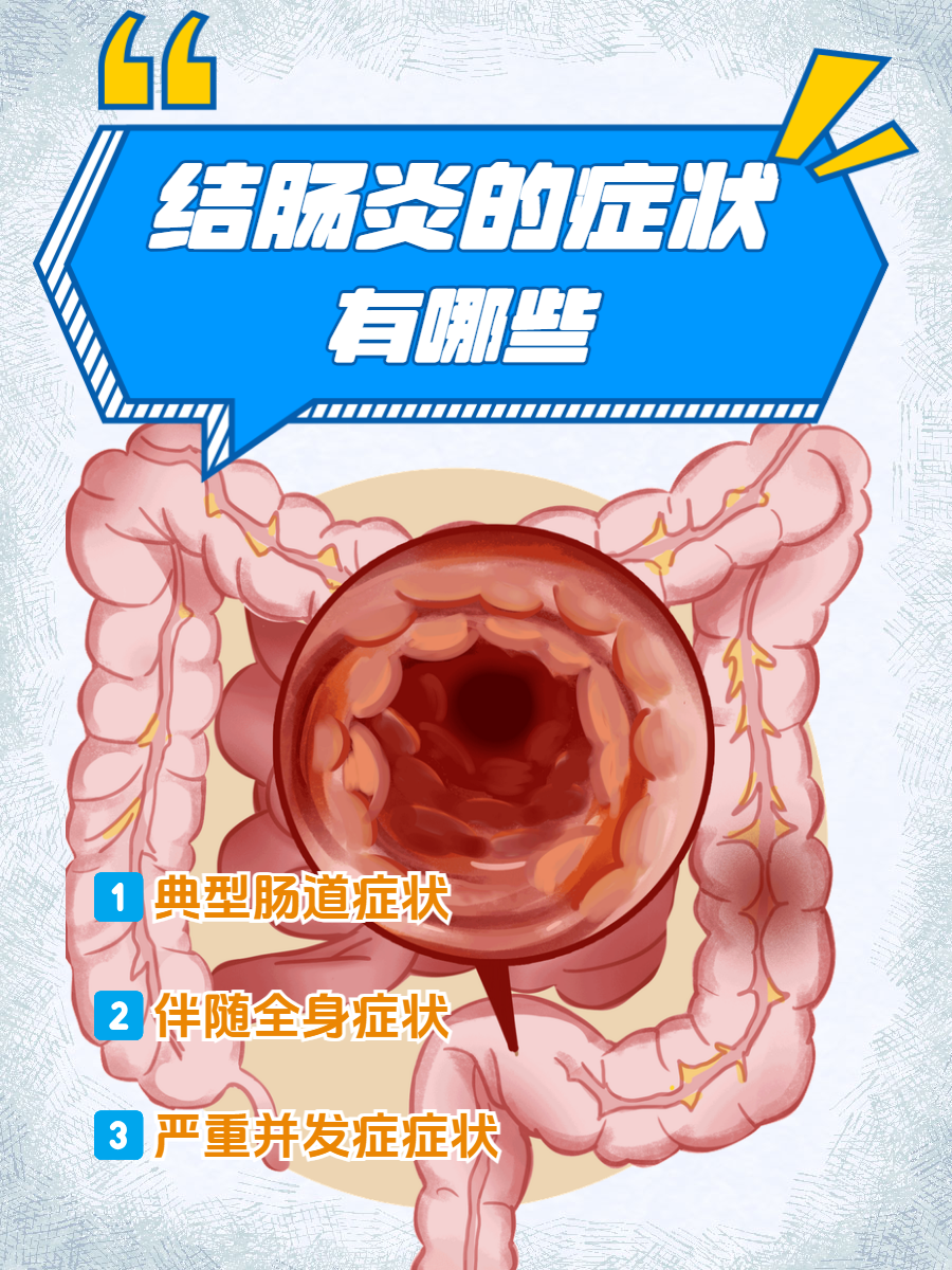 结肠炎的症状有哪些症状