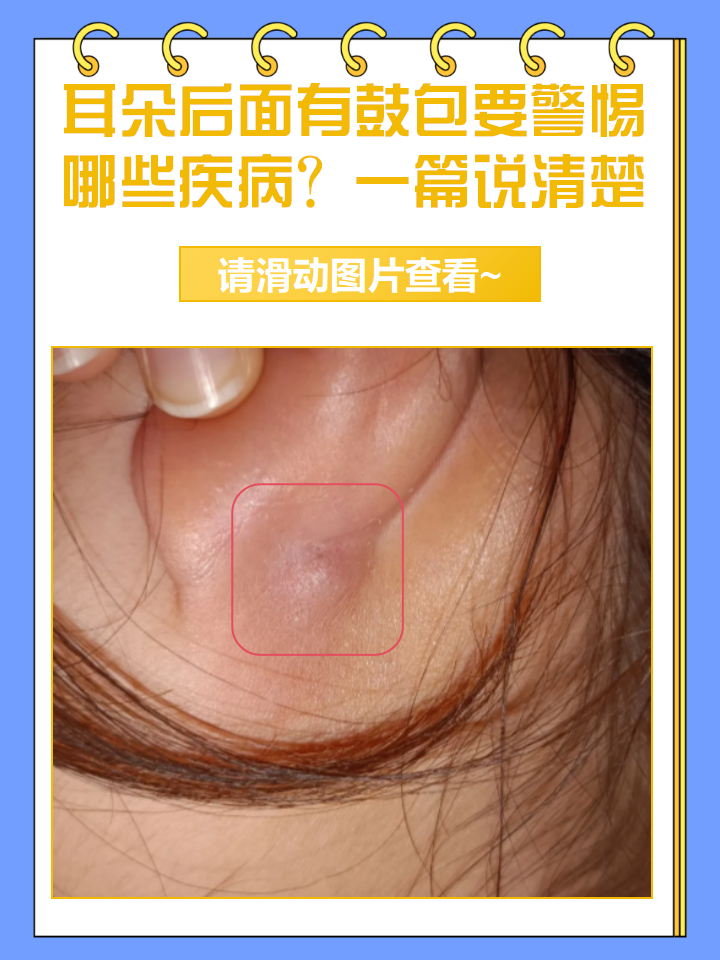 在日常生活中,如果耳朵后面出现鼓包,大家一定要引起重视