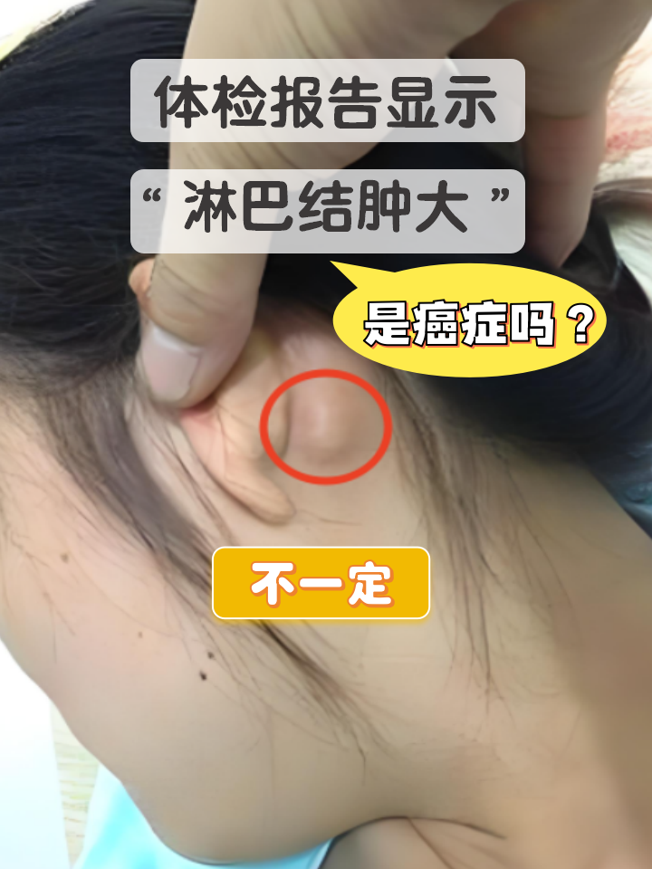去医院检查,报告可能显示"淋巴结肿大"