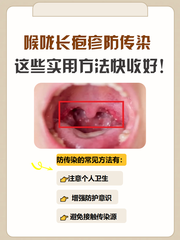 喉咙长疱疹在医学上常见于疱疹性咽峡炎,手足口病等疾病,渡由