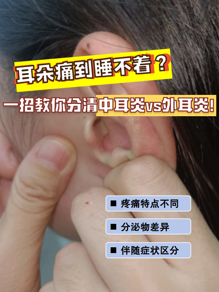 中耳炎和外耳炎如何区别 疼痛特点不同:中耳炎疼痛通常深在耳道目部