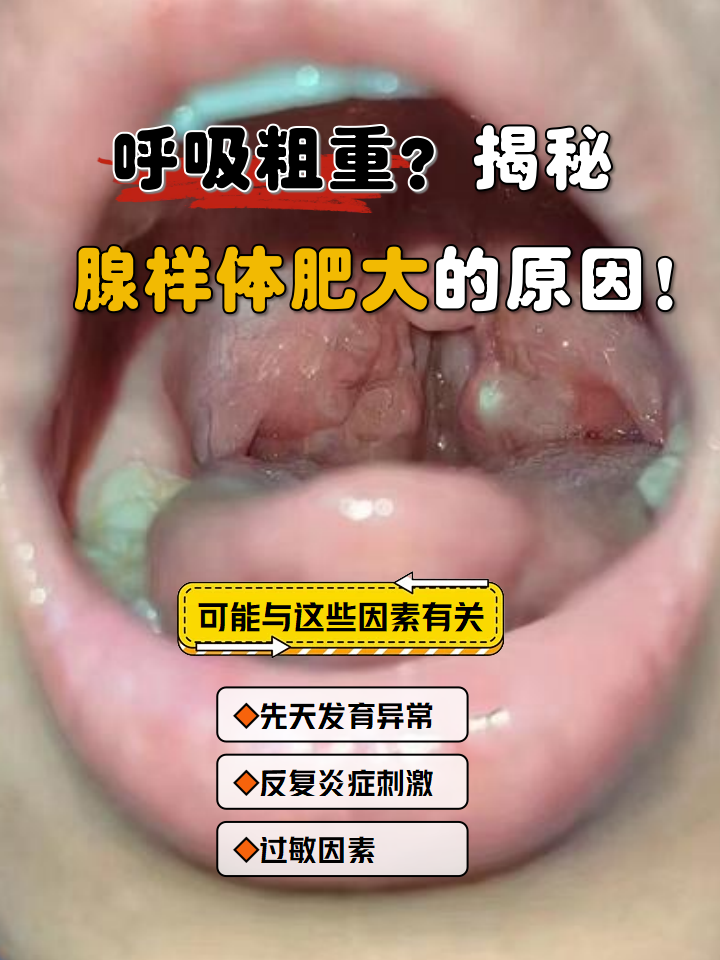 那么腺样体肥大是什么原因引起的呢