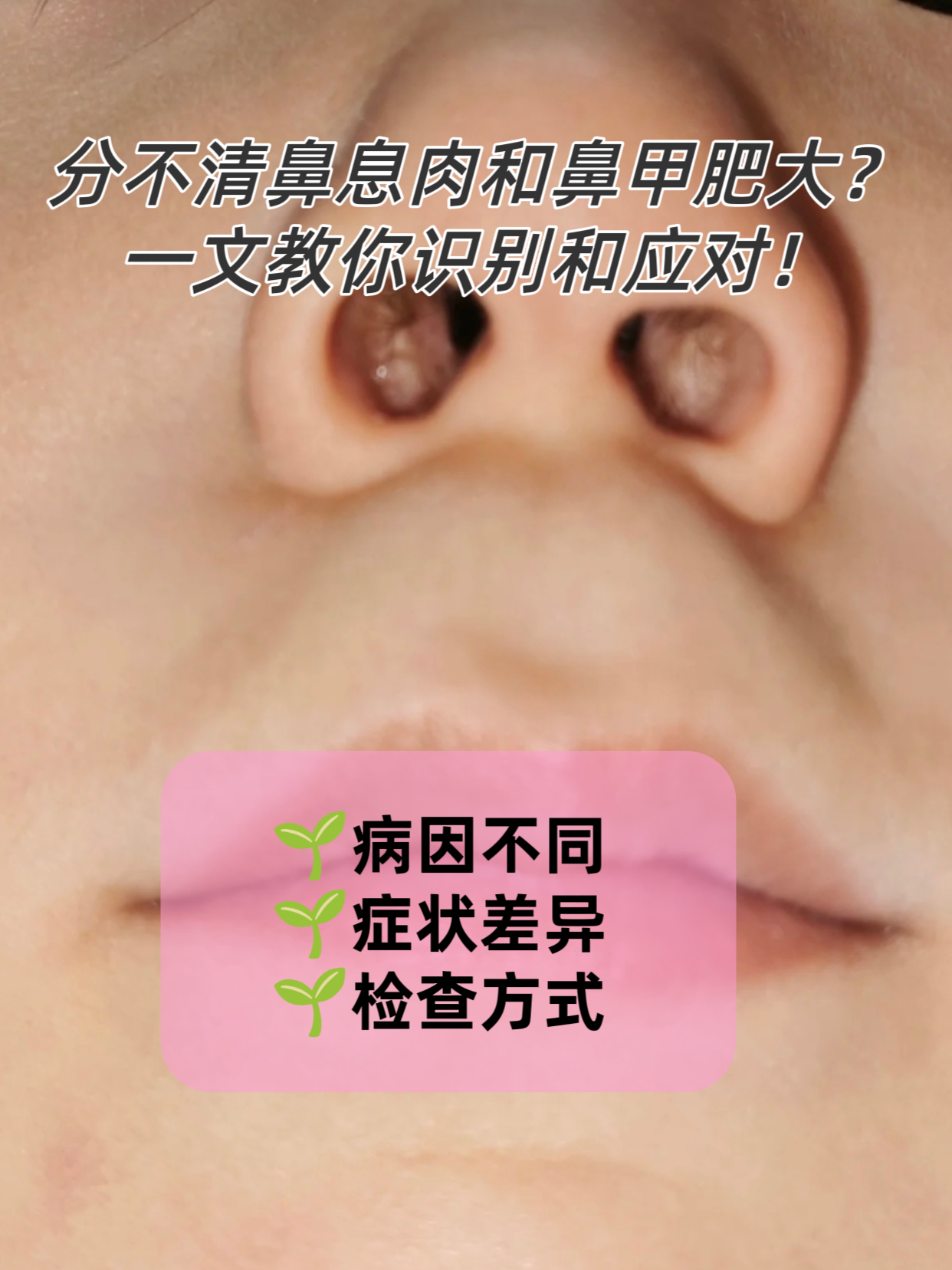 鼻塞,呼吸不畅,很多人第一时间想到感冒或鼻炎,但鼻息肉和鼻甲肥大