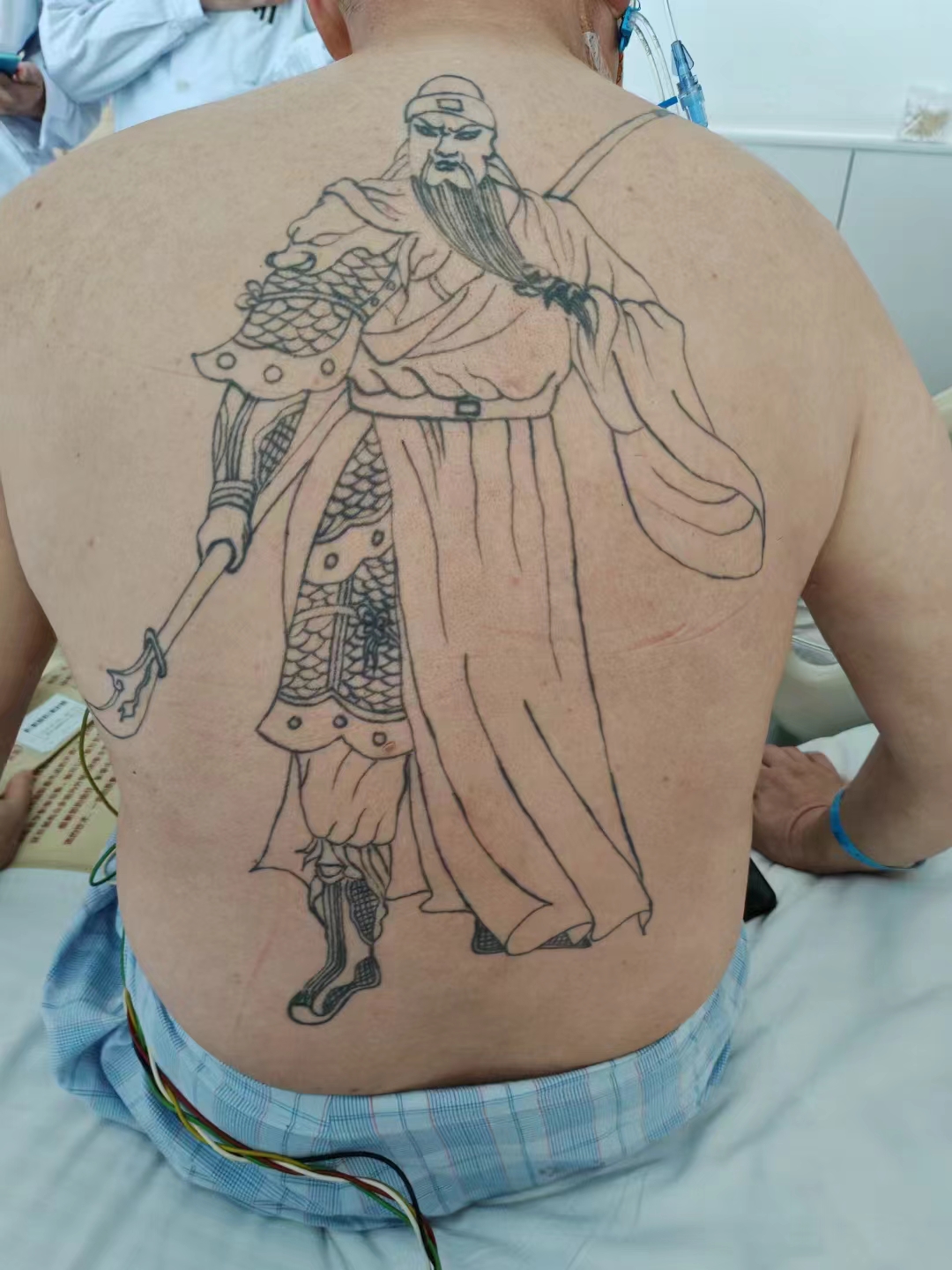 微创瓣膜手术患者及微创多支冠脉搭桥的患者近期来院