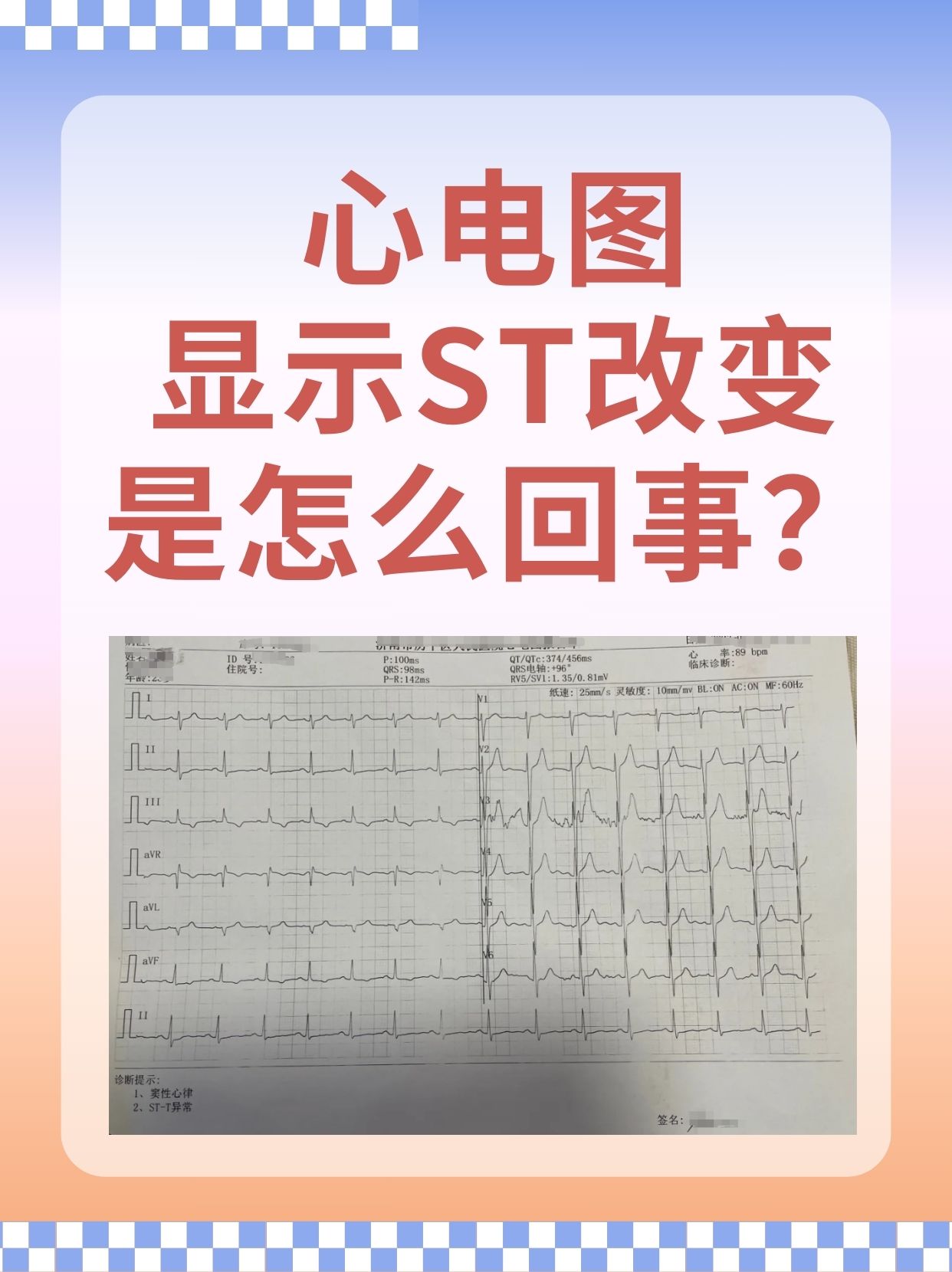 心脏漏搏的心电图图片