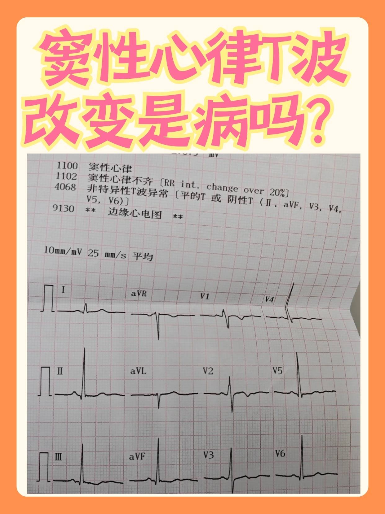 心电图T波双向图片