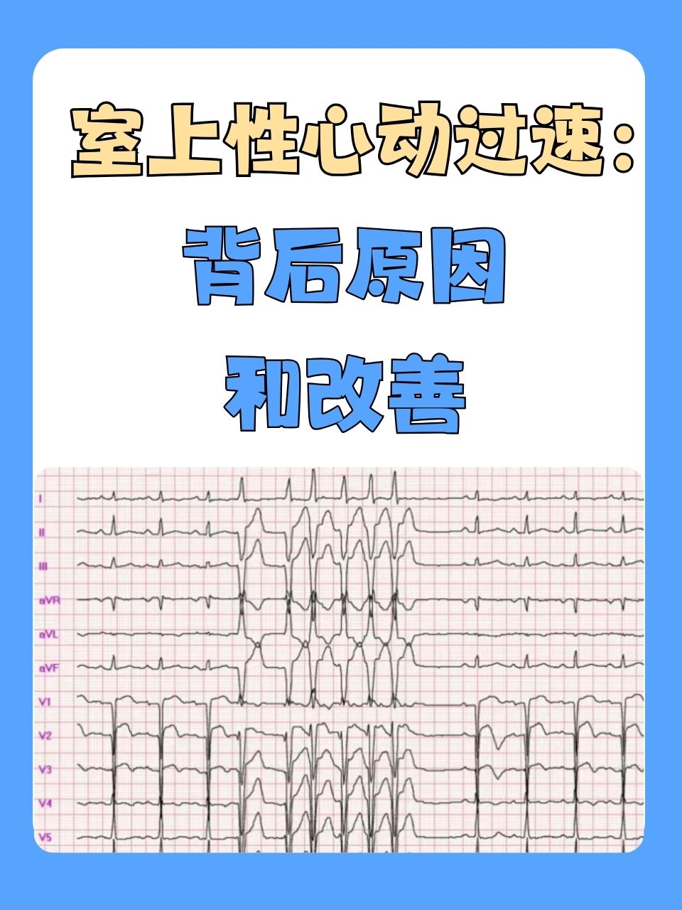 室上性心动过速:背后原因和改善 在快节奏的生活中,心脏健康成为了