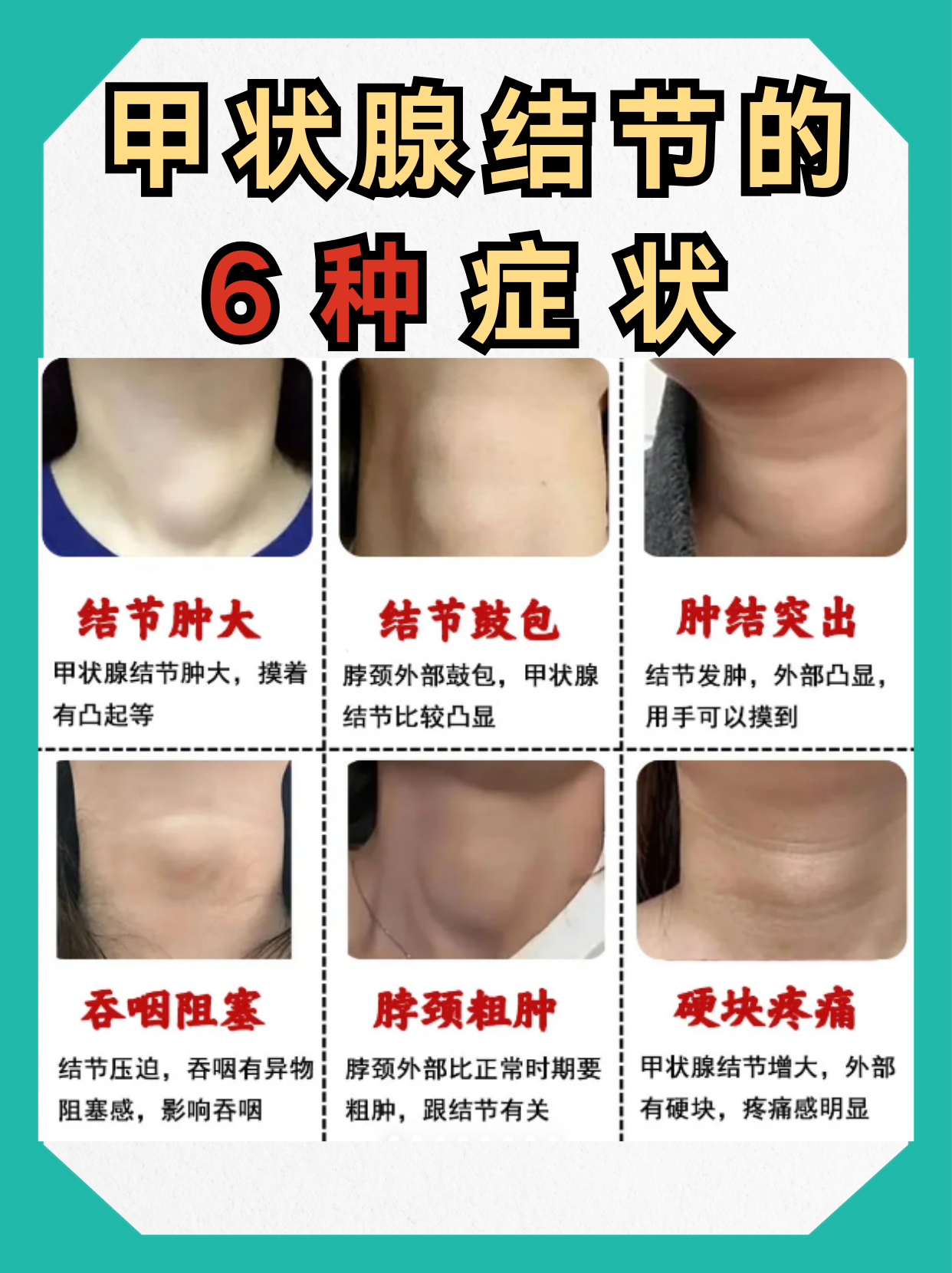 甲状腺结节症状多样,小的结节可能无症状,大的会有压迫感,部分