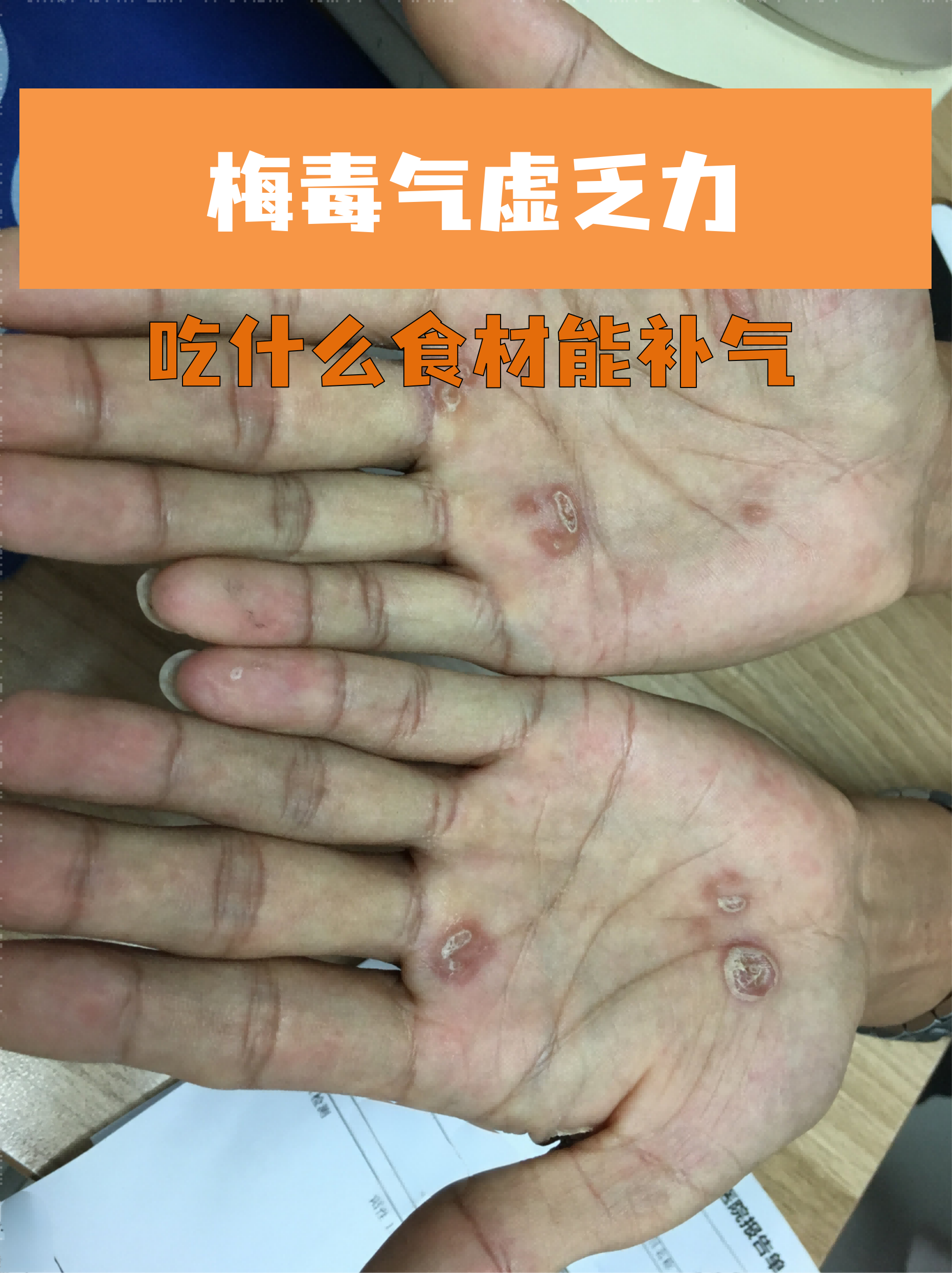 梅毒气虚乏力吃什么食材能补气