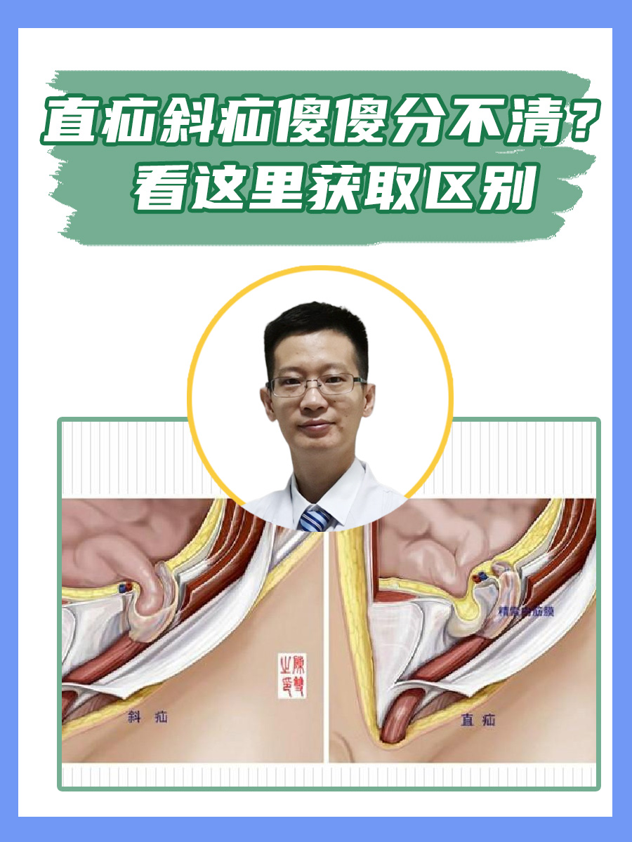 看这里获取区别  腹股沟疝是一个常见的外科疾病,而直疝和斜疝作为腹