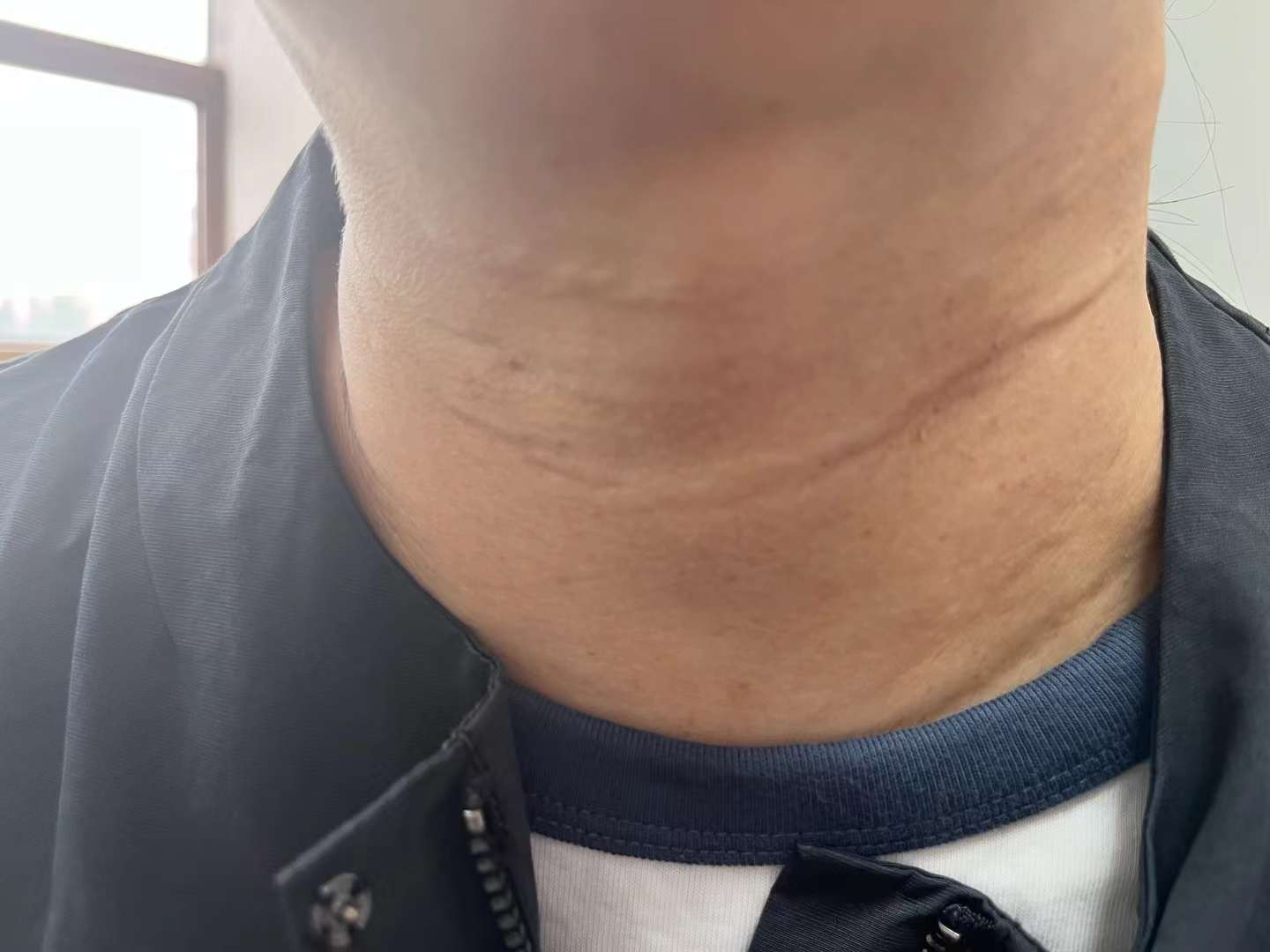 一位患者,跟同事一起在美容院打颈纹6个月下不去,已经形成条索状增生