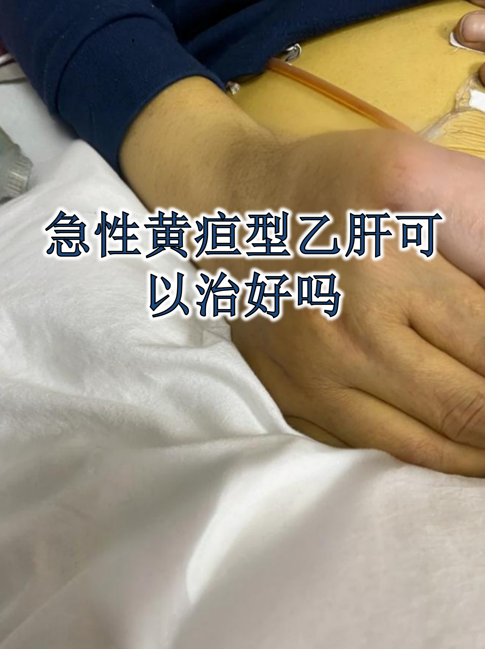 急性黄疸型乙肝可以治好吗