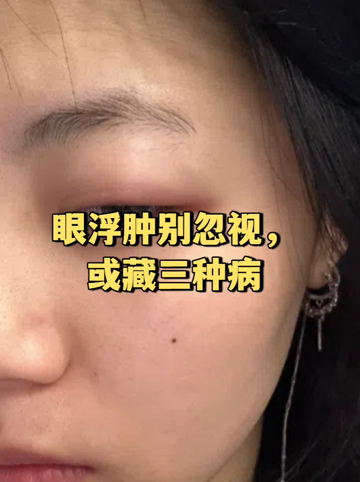眼浮肿别忽视,或藏三种病 眼睛浮肿是常见现象,但有时是疾病信号
