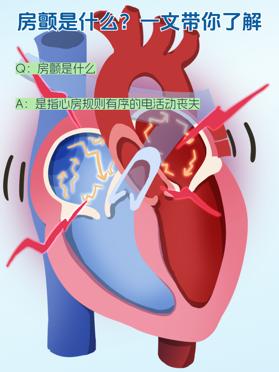 阵发性心房颤动图片