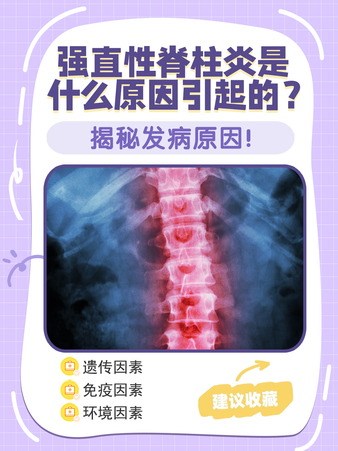 强直性脊柱炎是一种原因未明的慢性炎症性疾病,主要累及中轴骨骼
