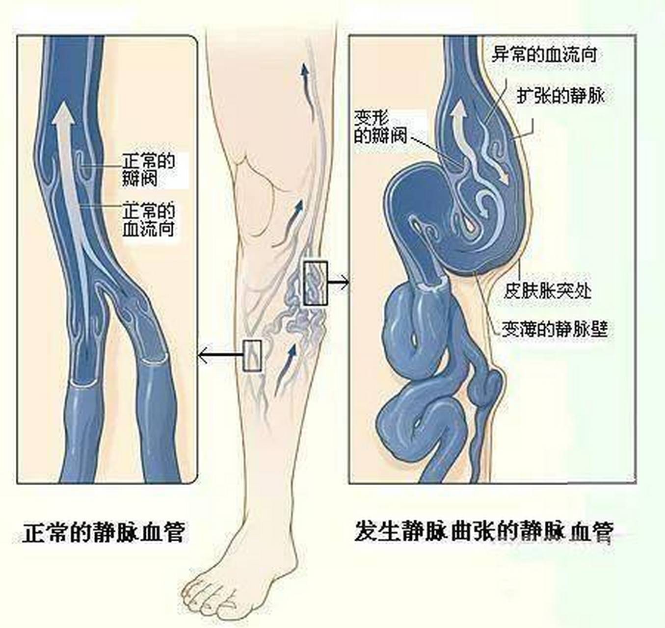 腿部静脉窦图片图片