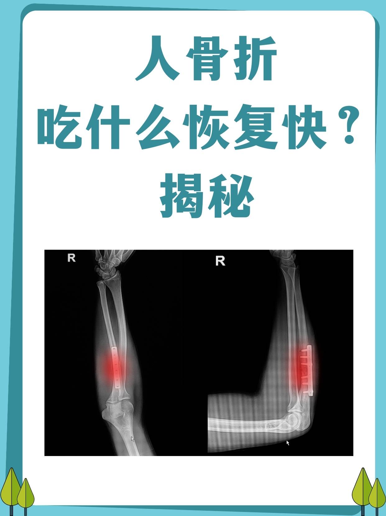 揭秘  骨折作为常见的骨骼损伤其恢复过程不仅需要